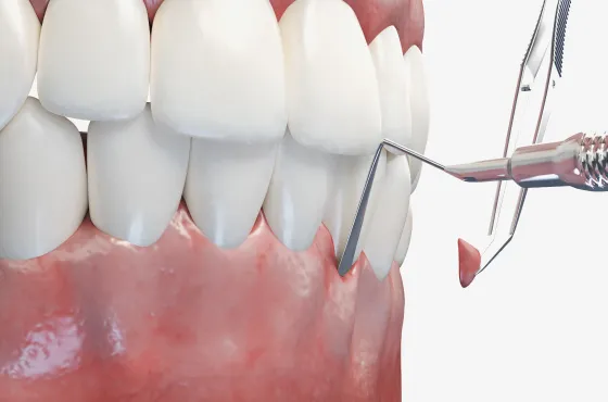 歯周組織再生療法
