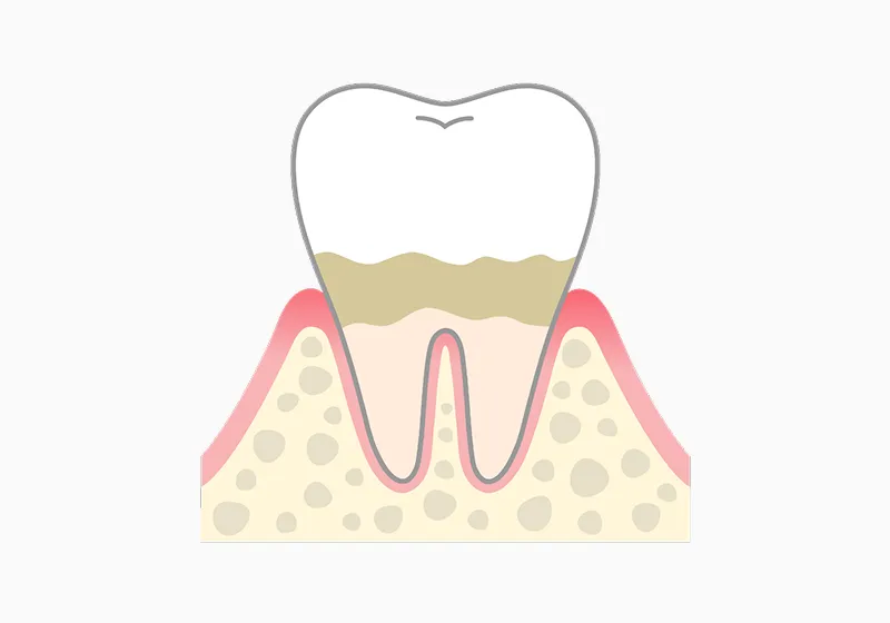 歯肉炎：歯ぐきの腫れ・出血の初期サイン