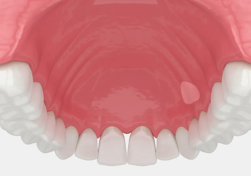 CTG（結合組織移植術）