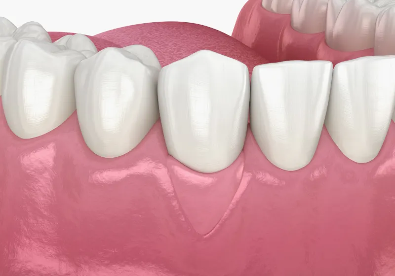 FGG（遊離歯肉移植術）