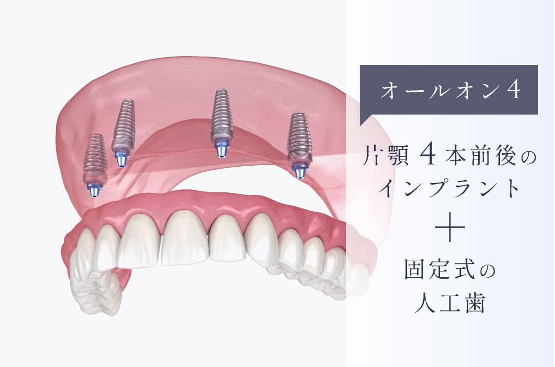 オールオン4 片顎4本前後のインプラント+固定式の人工歯
