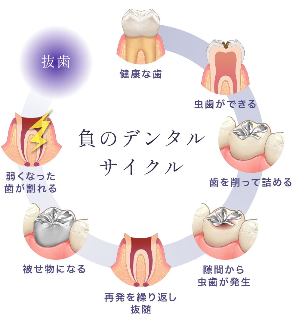負のデンタルサイクル。健康な歯→虫歯ができる→歯を削って詰める→隙間から虫歯が発生→再発を繰り返し抜随→被せ物になる→弱くなった歯が割れる→抜歯