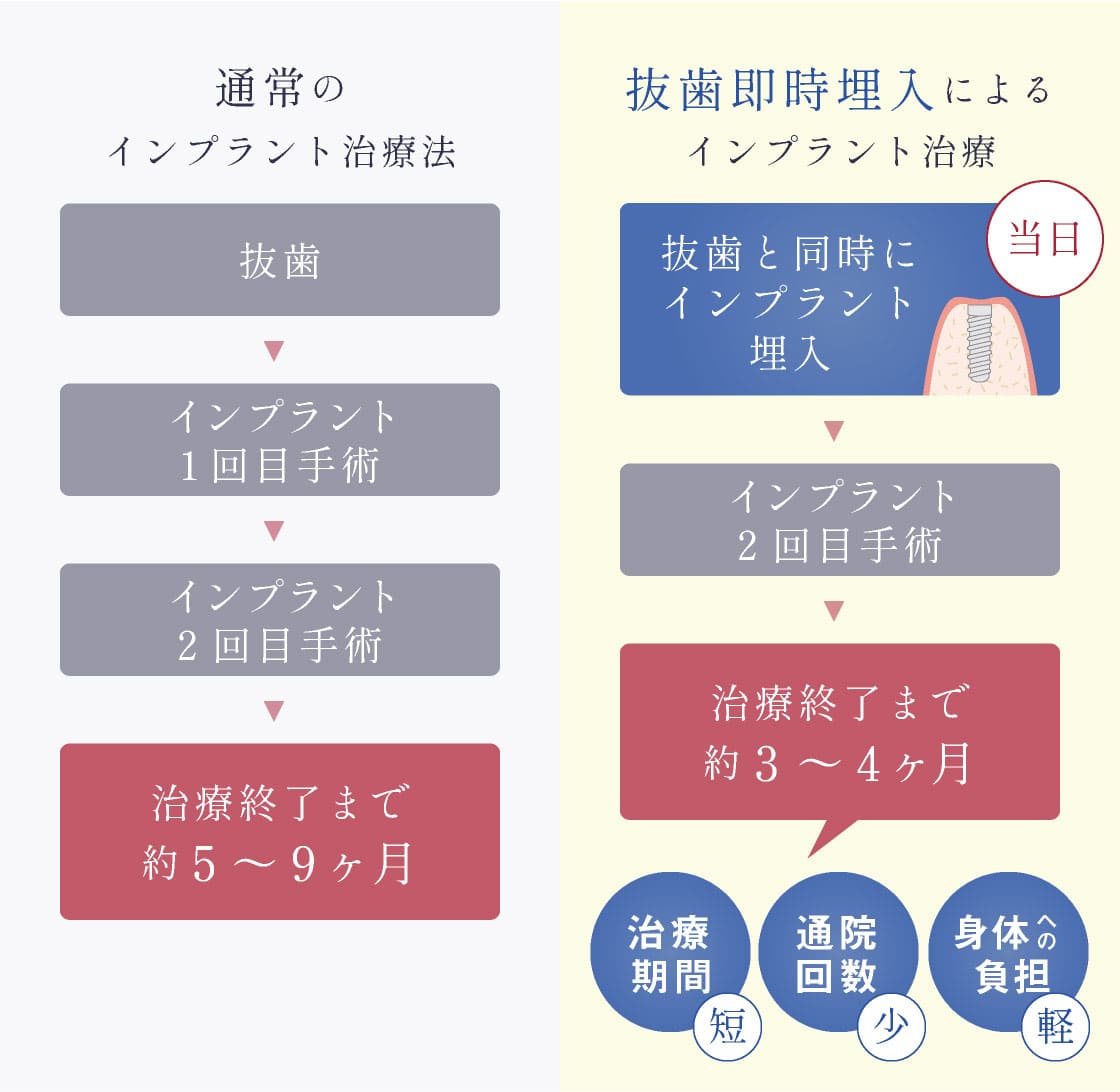 通常のインプラント治療法と、抜歯即時埋入によるインプラント治療の比較。抜歯と同時に当日インプラント埋入→インプラント2回目手術→治療完了まで約3〜4ヶ月<治療期間短><通院回数少><身体への負担軽>