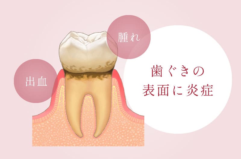 歯ぐきの表面に炎症