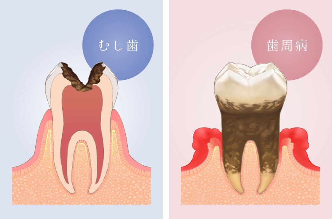むし歯・歯周病