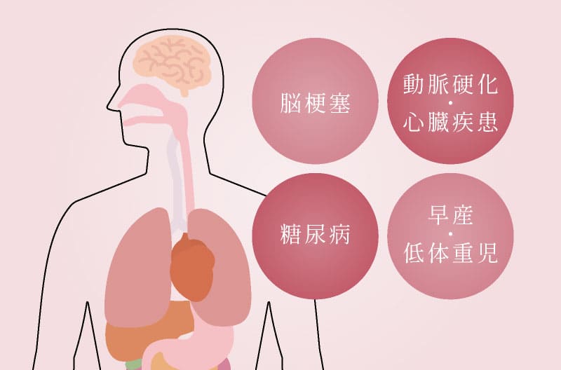脳梗塞・動脈硬化・心臓疾患・糖尿病・早産・低体重児