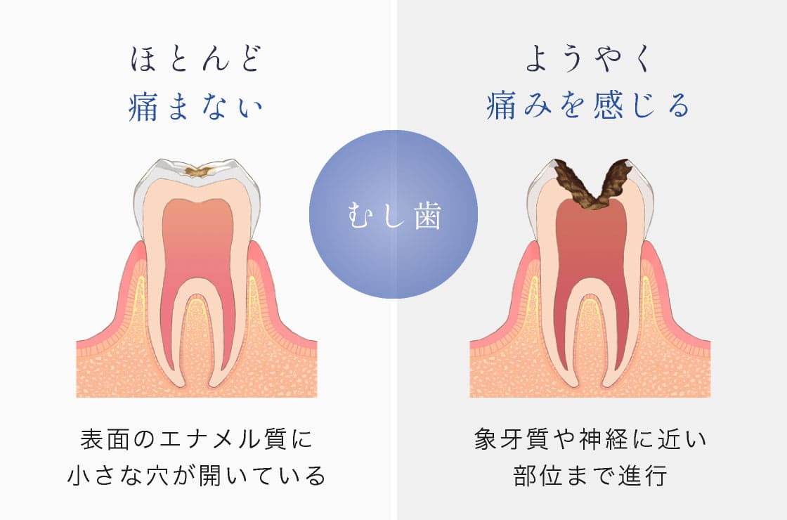むし歯 「ほとんど痛まない」…表面のエナメル質に小さな穴が開いている 「ようやく痛みを感じる」…象牙質や神経に近い部位まで進行