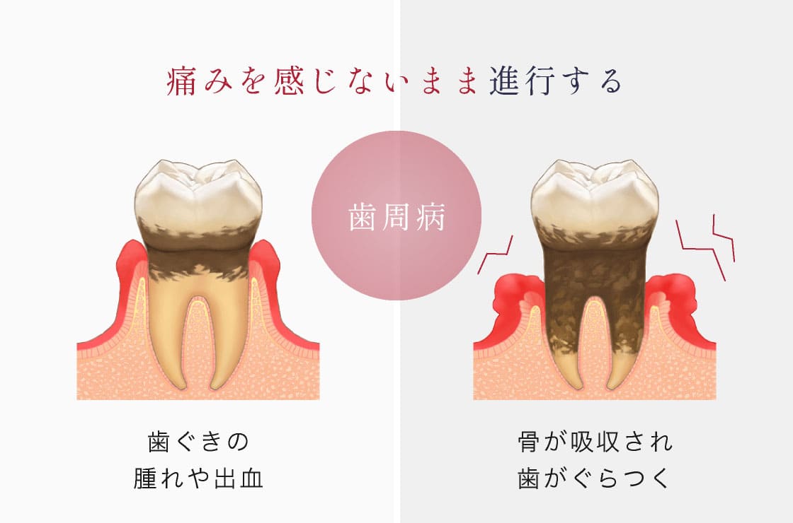 歯周病 「痛みを感じないまま進行する」…歯ぐきの腫れや出血、骨が吸収され歯がぐらつく