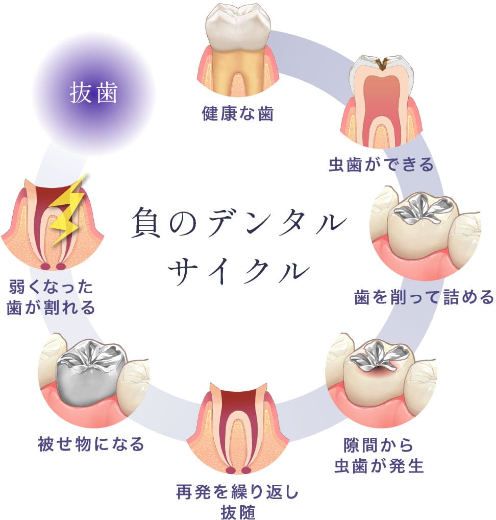 負のデンタルサイクル。健康な歯→虫歯ができる→歯を削って詰める→隙間から虫歯が発生→再発を繰り返し抜随→被せ物になる→弱くなった歯が割れる→抜歯