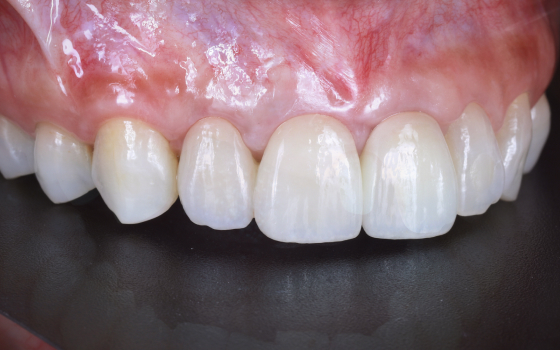 前歯一本のインプラント治療（術後）