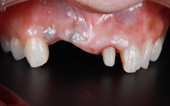 前歯一本のインプラント治療（術前）