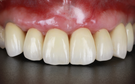 前歯部GBR（術後）