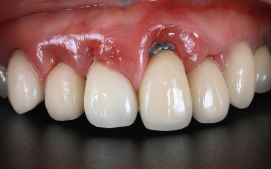 前歯部GBR（術前）