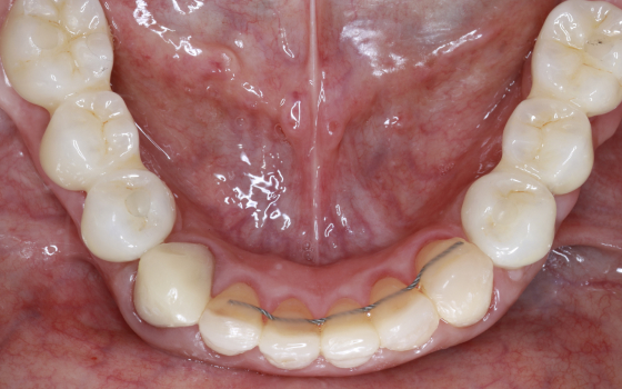 臼歯部GBR（術後）