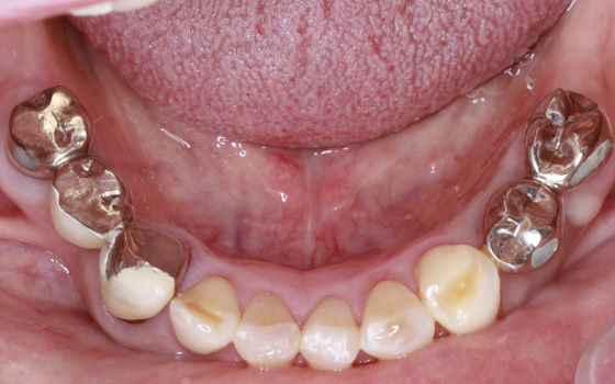 臼歯部GBR（術前）