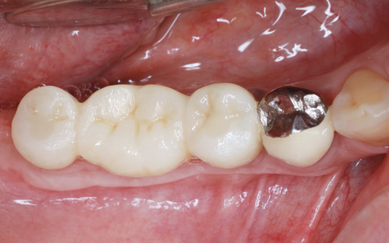 上顎奥歯の骨増生（術後）