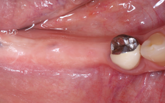 上顎奥歯の骨増生（術前）