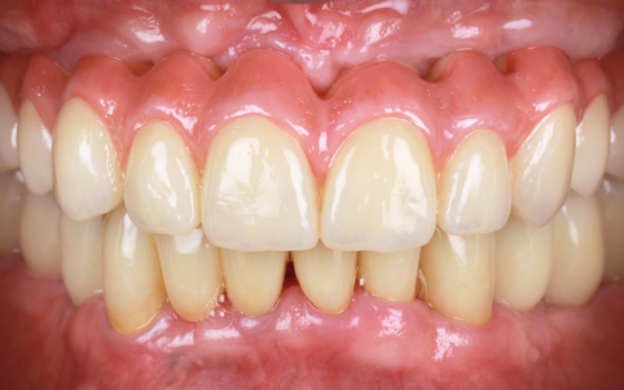 矯正併用インプラント（術後）