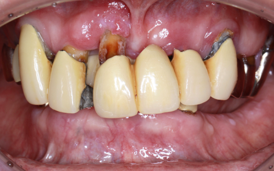 矯正併用インプラント（術前）