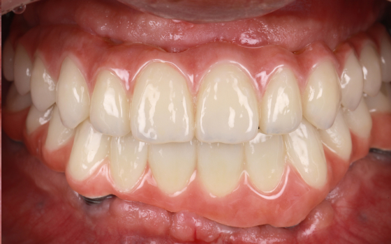 全く歯がない場合の治療（術後）