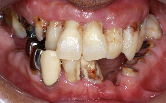 全く歯がない場合の治療（術前）