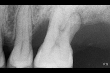 全顎インプラント_all-on-4 before