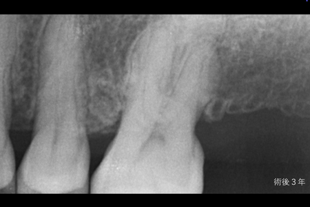 全顎インプラント_all-on-4 after