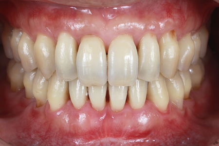 全顎インプラント_all-on-4 after