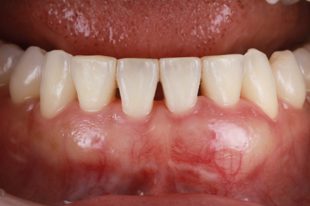 全顎インプラント_all-on-4 after