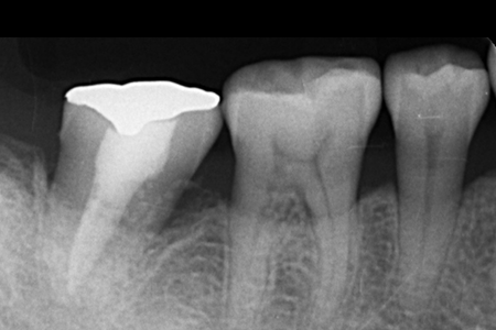 全顎インプラント_all-on-4 after