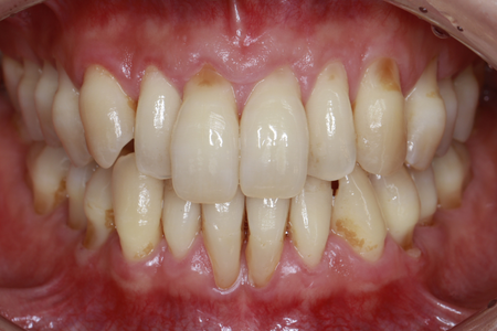 全顎インプラント_all-on-4 before