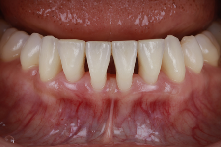 全顎インプラント_all-on-4 before